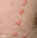 xanthoma eruptive