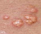 xanthoma eruptive