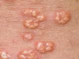 xanthoma eruptive
