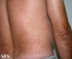 xanthoma eruptive