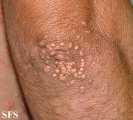 xanthoma eruptive