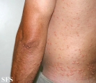 xanthoma eruptive