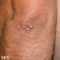 xanthoma eruptive