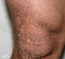 xanthoma eruptive