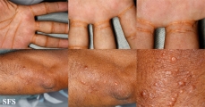 xanthoma eruptive