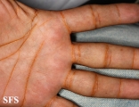 xanthoma eruptive