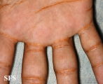 xanthoma eruptive