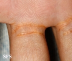 xanthoma eruptive