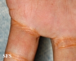xanthoma eruptive