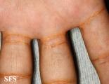 xanthoma eruptive