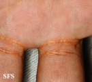 xanthoma eruptive