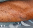 xanthoma eruptive