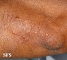 xanthoma eruptive
