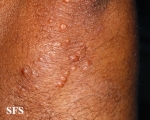 xanthoma eruptive