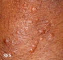 xanthoma eruptive