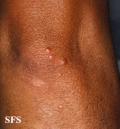xanthoma eruptive