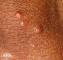 xanthoma eruptive