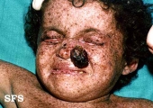 xeroderma pigmentosum