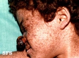 xeroderma pigmentosum