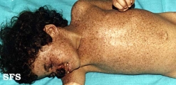 xeroderma pigmentosum