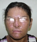 xeroderma pigmentosum
