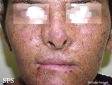 xeroderma pigmentosum