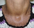 xeroderma pigmentosum