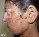 xeroderma pigmentosum