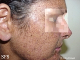 xeroderma pigmentosum