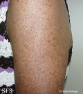 xeroderma pigmentosum