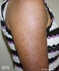 xeroderma pigmentosum