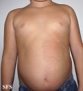 buschke-ollendorf syndrome