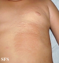 buschke-ollendorf syndrome