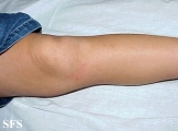 buschke-ollendorf syndrome