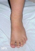 buschke-ollendorf syndrome