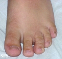 buschke-ollendorf syndrome