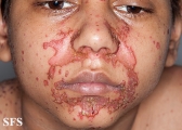 zinc deficiency