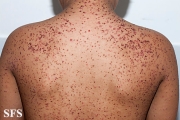 zinc deficiency