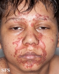 zinc deficiency