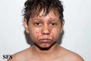 zinc deficiency