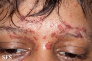 zinc deficiency