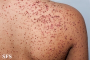 zinc deficiency