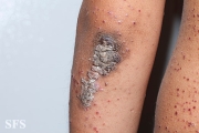 zinc deficiency