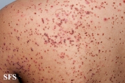 zinc deficiency