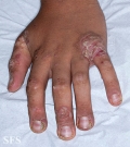 zinc deficiency