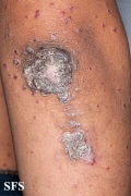 zinc deficiency