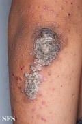zinc deficiency