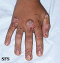 zinc deficiency