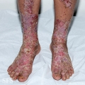 zinc deficiency