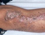 zinc deficiency